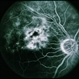 BRVO / Pseudo Macroaneurysm