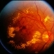 BRVO / Pseudo Macroaneurysm
