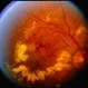 BRVO / Pseudo Macroaneurysm