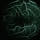 BRVO / Pseudo Macroaneurysm