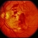 Trauma with Hemorrhages / Optic Nerve Swelling Trauma with Hemorrhages / Optic Nerve Swelling
