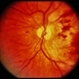 Trauma with Hemorrhages / Optic Nerve Swelling Trauma with Hemorrhages / Optic Nerve Swelling