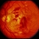 Trauma with Hemorrhages / Optic Nerve Swelling Trauma with Hemorrhages / Optic Nerve Swelling