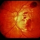 Trauma with Hemorrhages / Optic Nerve Swelling Trauma with Hemorrhages / Optic Nerve Swelling