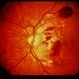 Trauma with Hemorrhages / Optic Nerve Swelling Trauma with Hemorrhages / Optic Nerve Swelling