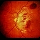 Trauma with Hemorrhages / Optic Nerve Swelling Trauma with Hemorrhages / Optic Nerve Swelling