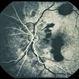 Trauma with Hemorrhages / Optic Nerve Swelling Trauma with Hemorrhages / Optic Nerve Swelling
