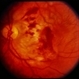 Trauma with Hemorrhages / Optic Nerve Swelling Trauma with Hemorrhages / Optic Nerve Swelling