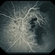 Trauma with Hemorrhages / Optic Nerve Swelling Trauma with Hemorrhages / Optic Nerve Swelling