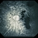 Trauma with Hemorrhages / Optic Nerve Swelling Trauma with Hemorrhages / Optic Nerve Swelling