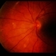 Uveal Effusion Uveal Effusion