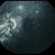 Uveal Effusion Uveal Effusion