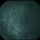 Uveal Effusion Uveal Effusion