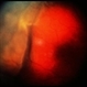 Uveal Effusion Uveal Effusion