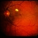 Uveal Effusion Uveal Effusion