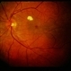 Uveal Effusion Uveal Effusion