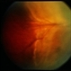 Uveal Effusion Uveal Effusion