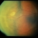 Uveal Effusion Uveal Effusion