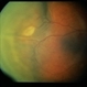 Uveal Effusion Uveal Effusion