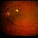 Uveal Effusion Uveal Effusion