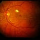 Uveal Effusion Uveal Effusion