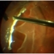 Retinectomy With Diathermy in a Giant Tear