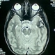 Cavernous Hemangioma of the Retina Cavernous Hemangioma of the Retina