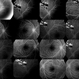 Cavernous Hemangioma of the Retina Cavernous Hemangioma of the Retina