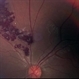 Cavernous Hemangioma of the Retina