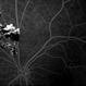 Cavernous Hemangioma of the Retina Cavernous Hemangioma of the Retina