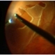 Myopic Giant Tear