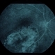 Amelanotic Malignant Melanoma Amelanotic Malignant Melanoma