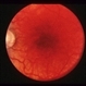CNVM - Myopic CNVM - Myopic