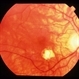 CNVM - Myopic