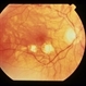 CNVM - Myopic