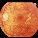 CNVM - Myopic CNVM - Myopic