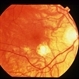 CNVM - Myopic CNVM - Myopic