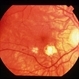 CNVM - Myopic CNVM - Myopic