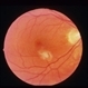 Ocular Histoplasmosis Syndrome (OHS)