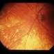 Uveitis