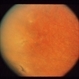 Intraocular Inflammation