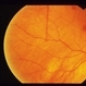 Sub-Arachnoid Hemorrhage