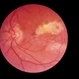 Ocular Histoplasmosis With Macular Changes
