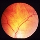 Multiple Retinal Arterial Macroaneurysms