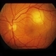Subretinal Hemorrhage With Exudative Detachment