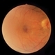 Retinoschisis Secondary To Pars Planitis