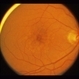 Small Macular Hemorrhage