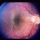 Gyrate Atrophy