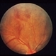 Vasculitis With Neovascularization