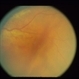 Severe Commotio Retinae With Edema And Hemorrhages